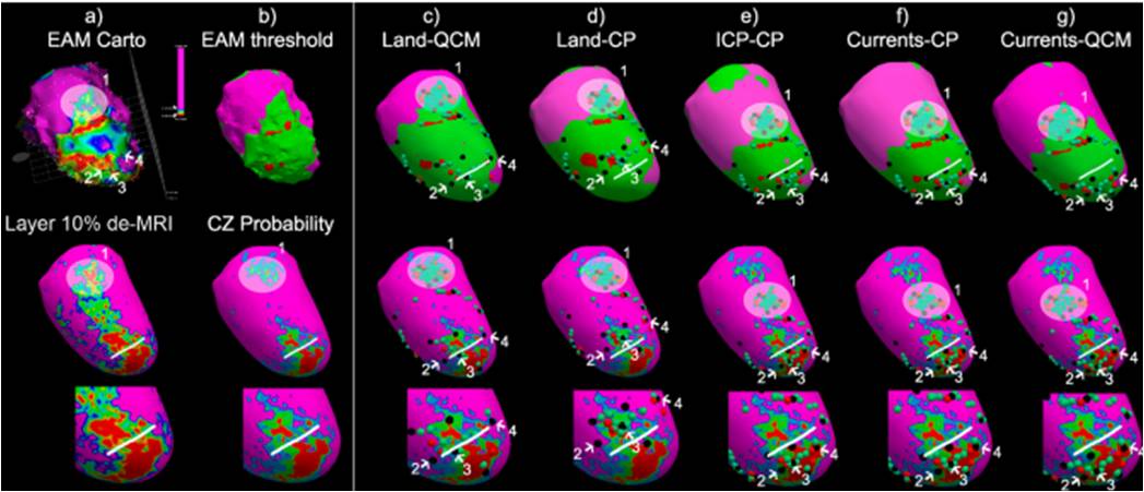 Fig. 8. Integration of EAM and DE-MRI data from a clinical case with a complex scar having a conduction channel (CC, white line) visible in DE-MRI. Top row: (a) EAM data visualized in the CARTO viewer; (b) EAM data with tissue characterization obtained with standard thresholds (core zone, CZ in red; border zone, BZ, in green; healthy tissue, HT, in pink); (c–g) EAM tissue labels mapped on the DE-MRI geometry after applying the different integration methodologies (quasi-conformal, QCM, and closest point, CP, mapping techniques are combined with landmarks-based, Land, Iterative Closest Point, ICP, and currents registration algorithms). Middle row: (a) 10% layer of the DE-MRI data with tissue characterization obtained with standard thresholds; (b) CZ transmural map, from 0 (pink) to 1 (red); (c–g) Annotated EAM points mapped over DE-MRI geometry after applying the different integration methodologies. Double potential points (green, e.g. cloud of points 1), ablation points (red), CC entrances (black, e.g. points 2, 3 and 4) are shown. Bottom row: zoom of middle row around the conduction channels. (For interpretation of the references to color in this figure legend, the reader is referred to the web version of this article.)